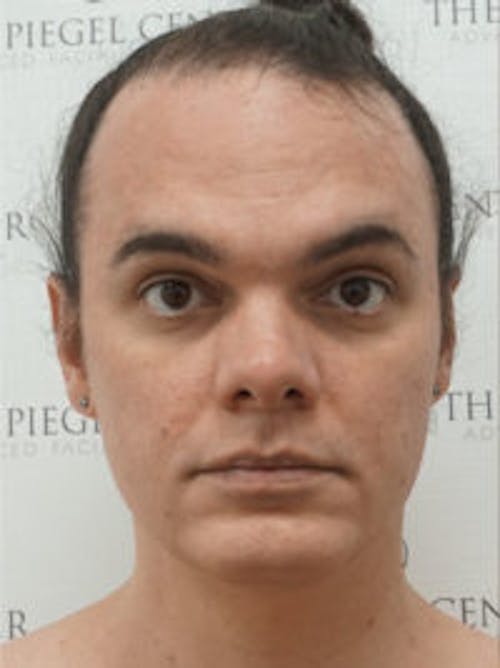 FFS Before & After Gallery - Patient 198736 - Image 1