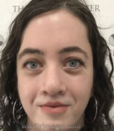 FFS Before & After Gallery - Patient 139578 - Image 3