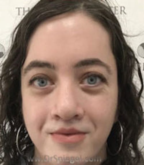 FFS Before & After Gallery - Patient 139578 - Image 3