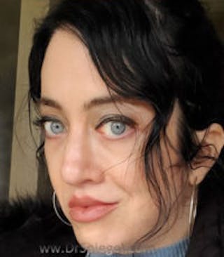 FFS Before & After Gallery - Patient 139578 - Image 4