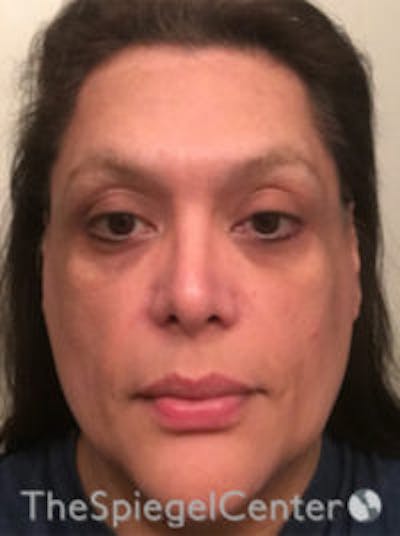 FFS Before & After Gallery - Patient 191036 - Image 1