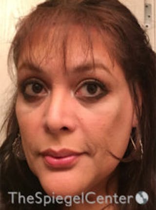 FFS Before & After Gallery - Patient 191036 - Image 2