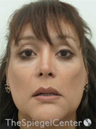 FFS Before & After Gallery - Patient 191036 - Image 3