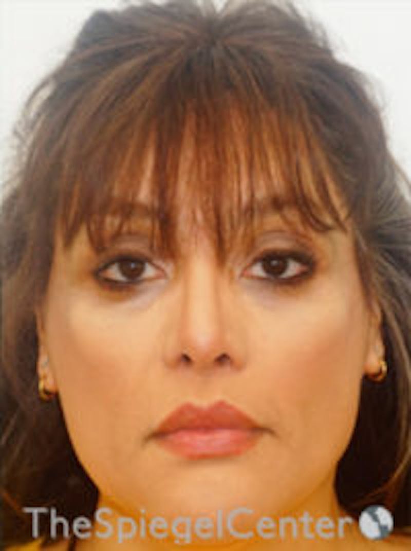 FFS Before & After Gallery - Patient 191036 - Image 4