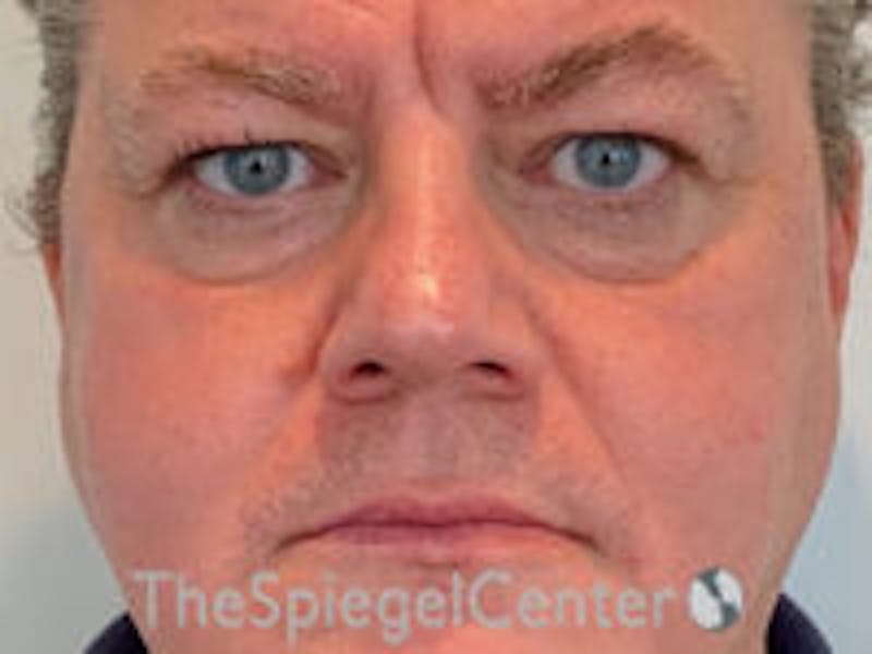 FFS Before & After Gallery - Patient 130791 - Image 1