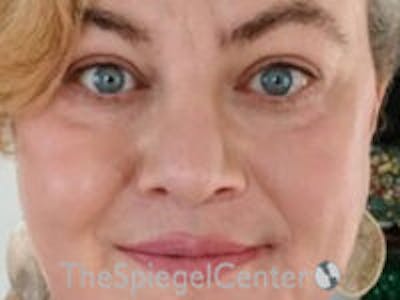 FFS Before & After Gallery - Patient 130791 - Image 2