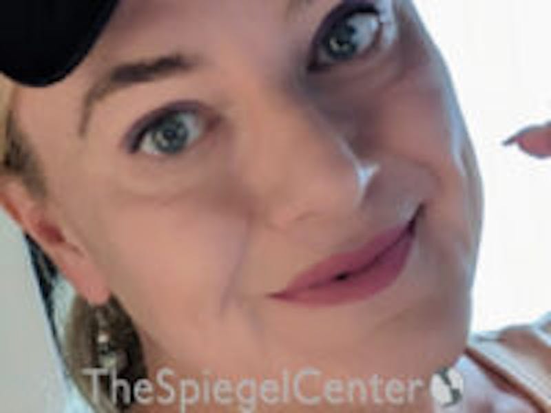 FFS Before & After Gallery - Patient 130791 - Image 4