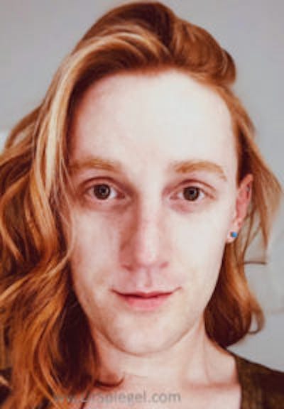 FFS Before & After Gallery - Patient 308363 - Image 2