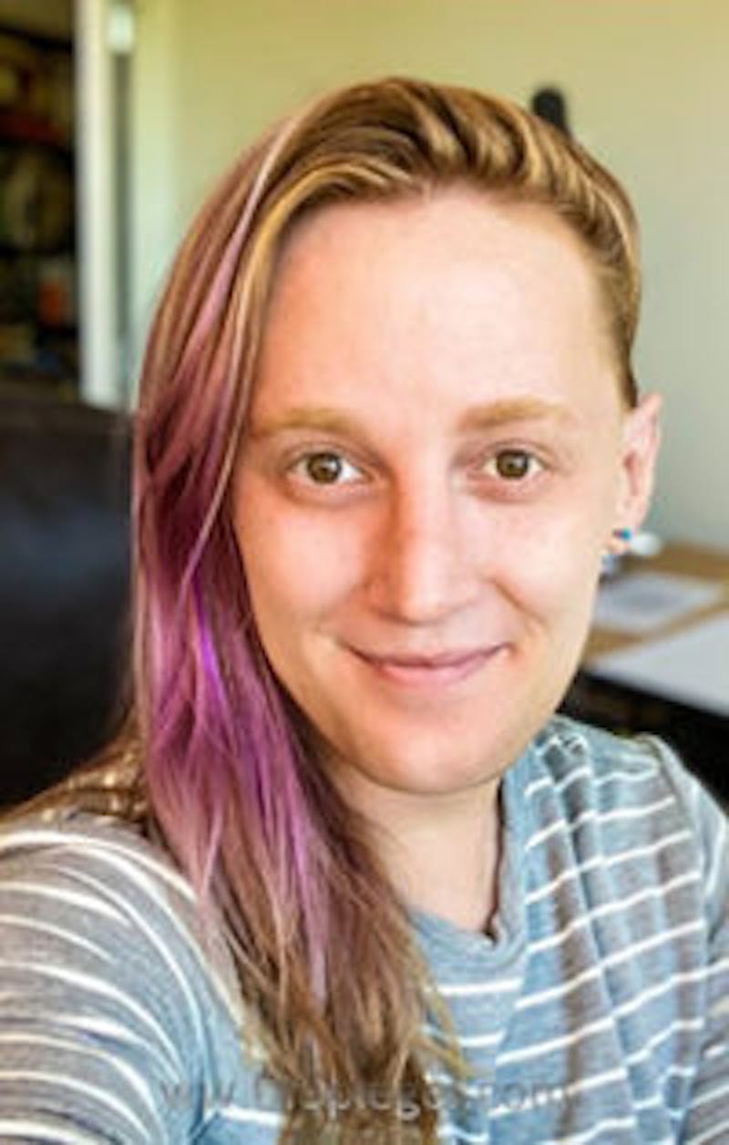 FFS Before & After Gallery - Patient 308363 - Image 4