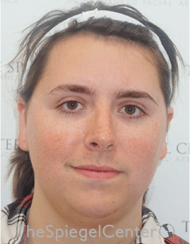 FFS Before & After Gallery - Patient 122153 - Image 1