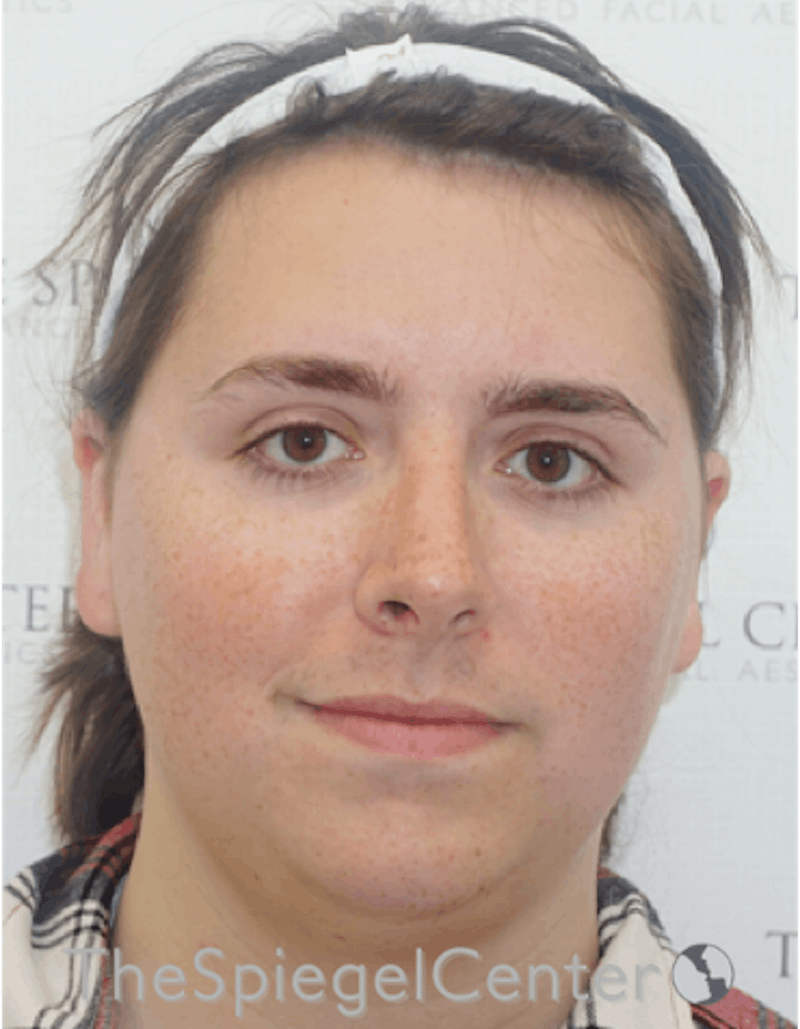 FFS Before & After Gallery - Patient 122153 - Image 1