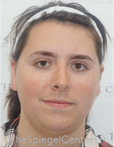 FFS Before & After Gallery - Patient 122153 - Image 1