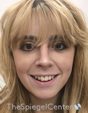FFS Before & After Gallery - Patient 122153 - Image 2