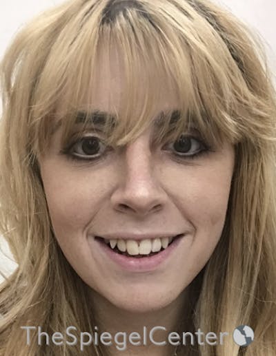 FFS Before & After Gallery - Patient 122153 - Image 2