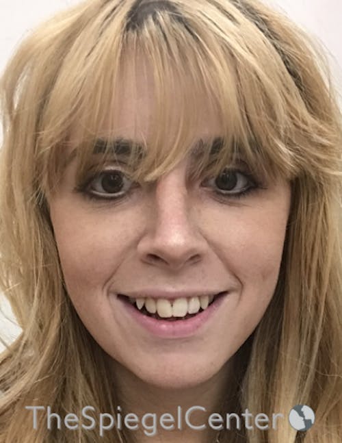 FFS Before & After Gallery - Patient 122153 - Image 2