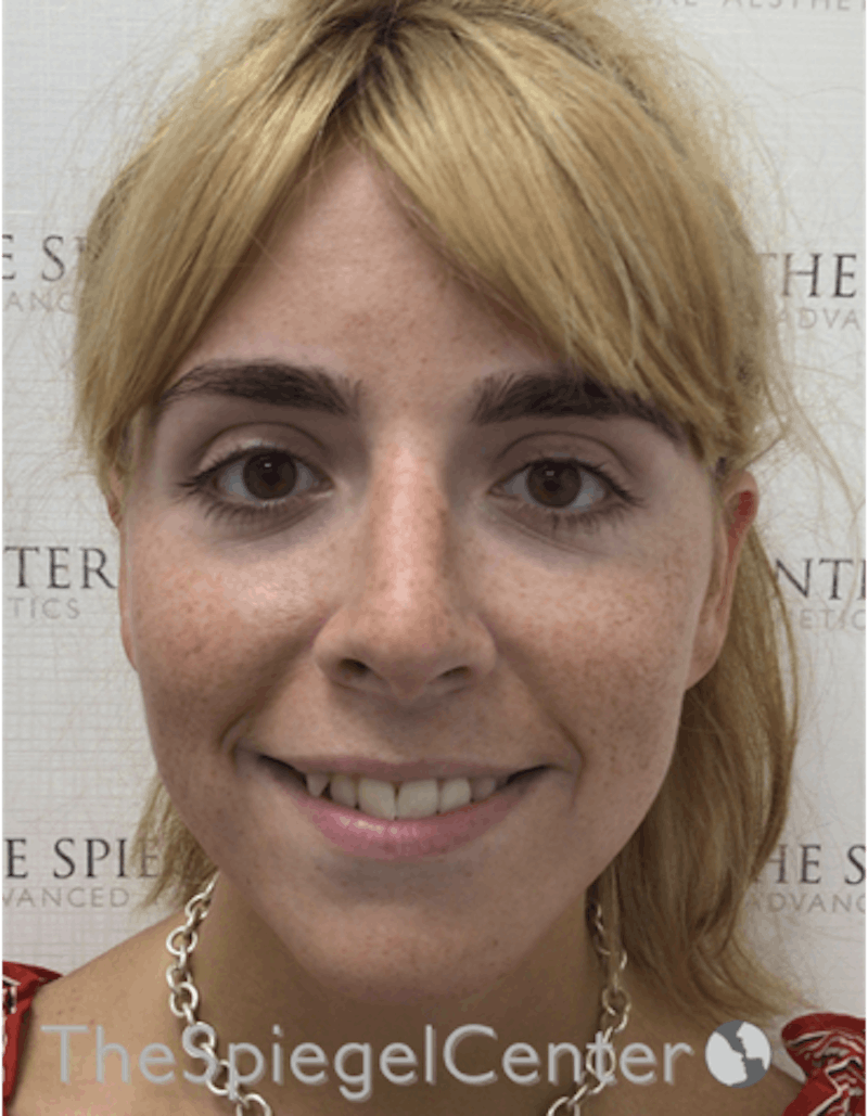 FFS Before & After Gallery - Patient 122153 - Image 3