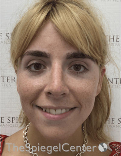 FFS Before & After Gallery - Patient 122153 - Image 3