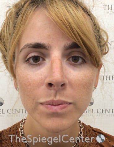 FFS Before & After Gallery - Patient 122153 - Image 4