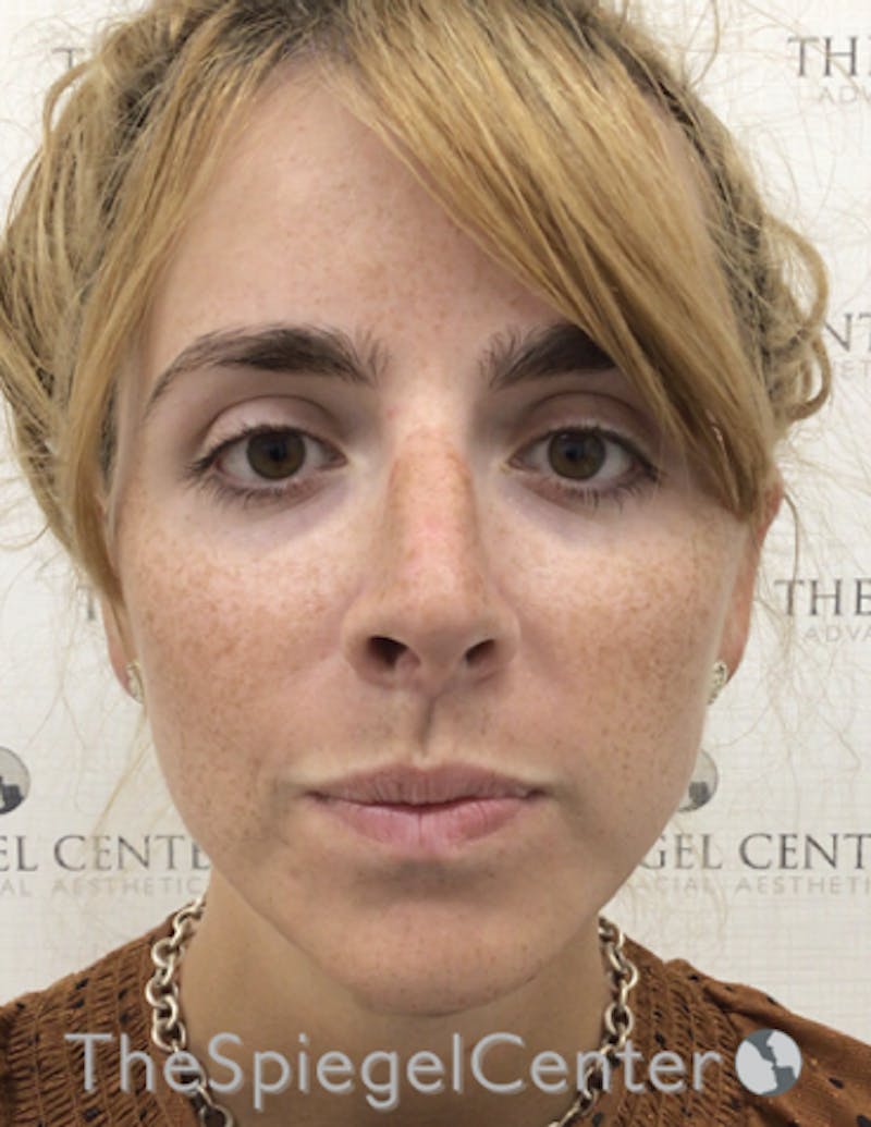 FFS Before & After Gallery - Patient 122153 - Image 4