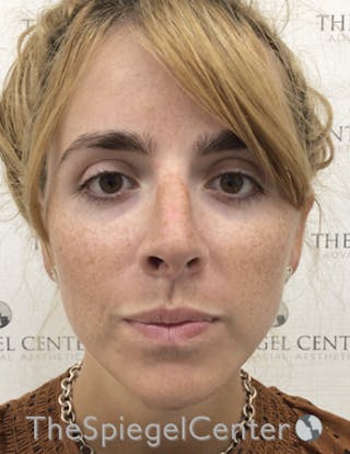 FFS Before & After Gallery - Patient 122153 - Image 4