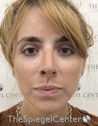 FFS Before & After Gallery - Patient 122153 - Image 4