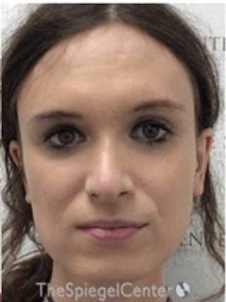 FFS Before & After Gallery - Patient 234216 - Image 2