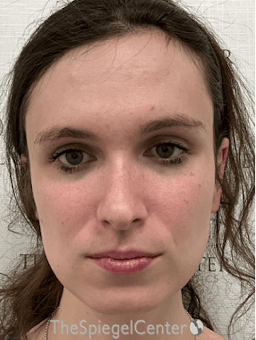 FFS Before & After Gallery - Patient 234216 - Image 3