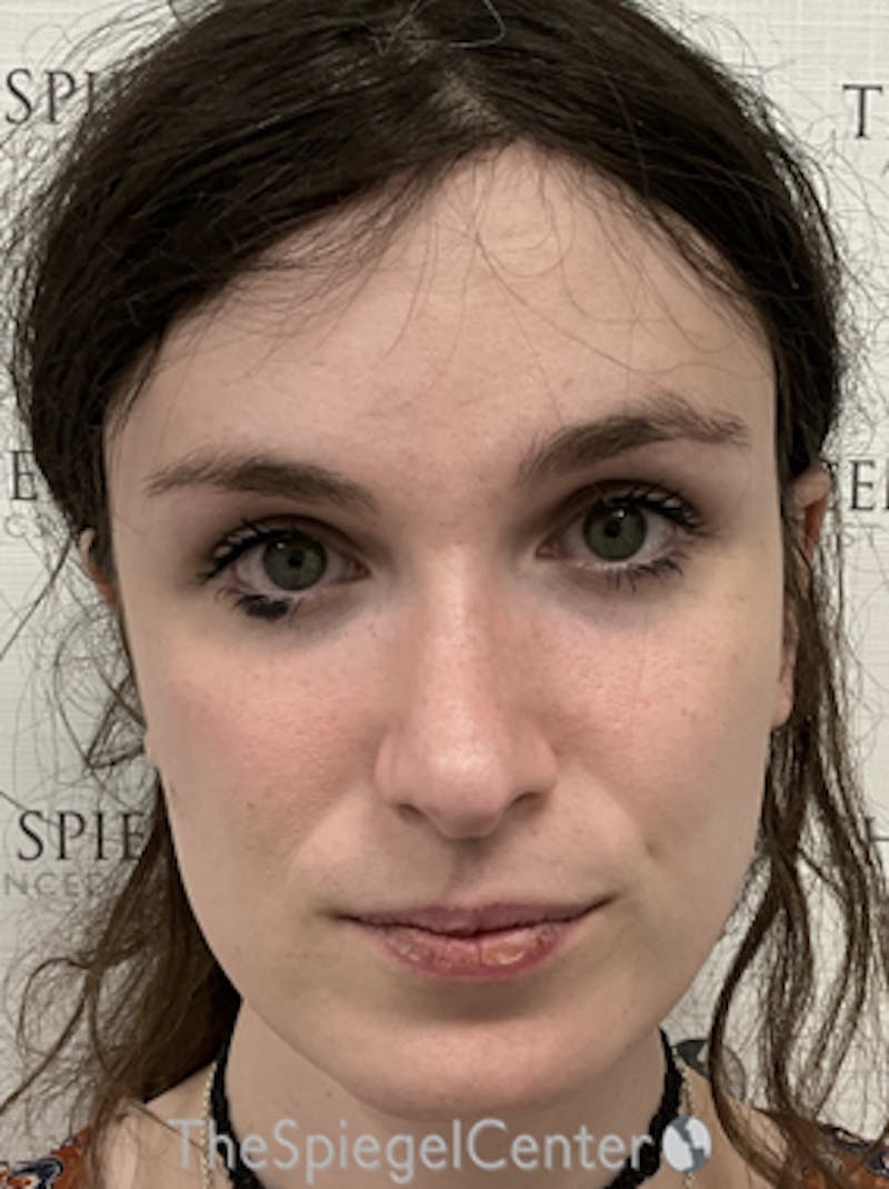 FFS Before & After Gallery - Patient 234216 - Image 4