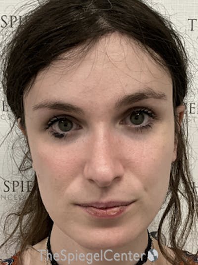 FFS Before & After Gallery - Patient 234216 - Image 4