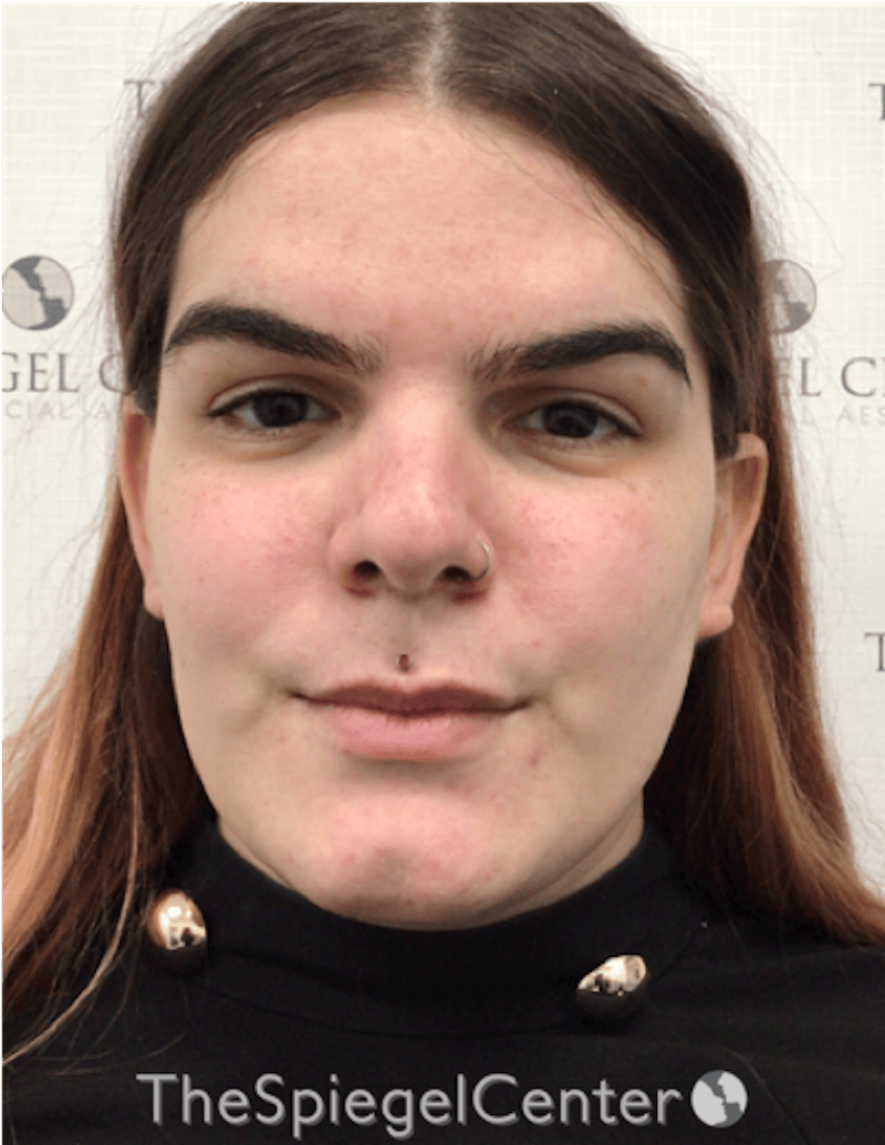 FFS Before & After Gallery - Patient 197639 - Image 1