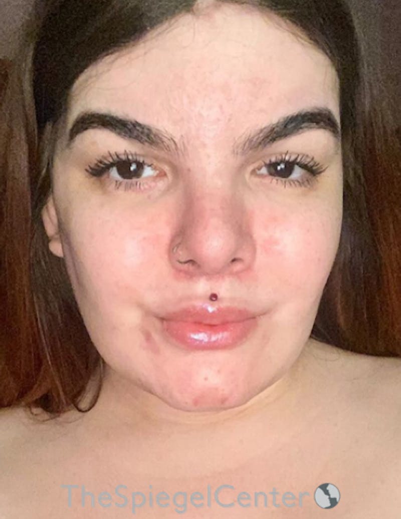 FFS Before & After Gallery - Patient 197639 - Image 2