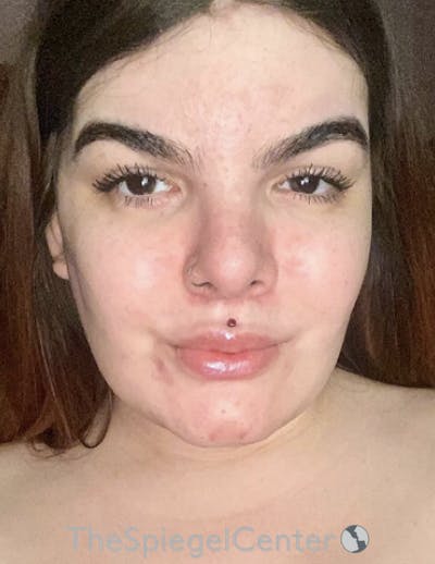 FFS Before & After Gallery - Patient 197639 - Image 2