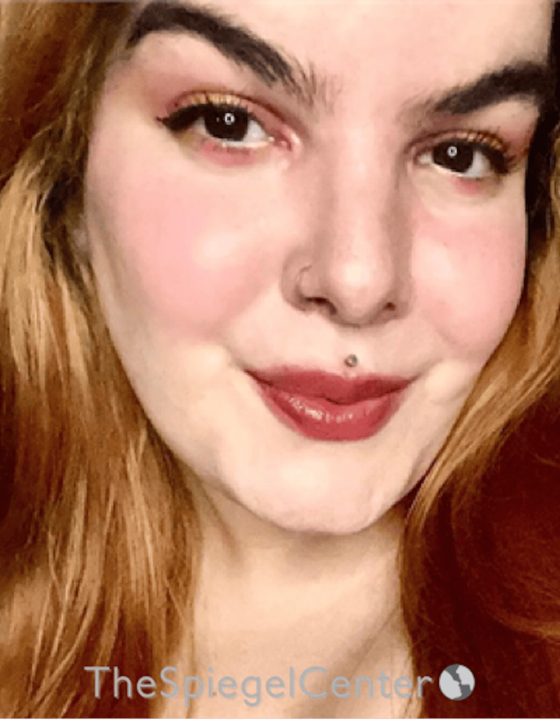 FFS Before & After Gallery - Patient 197639 - Image 4