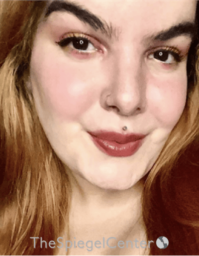 FFS Before & After Gallery - Patient 197639 - Image 4