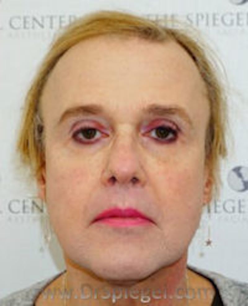 FFS Before & After Gallery - Patient 280457 - Image 1