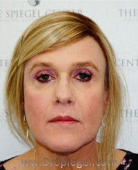 FFS Before & After Gallery - Patient 280457 - Image 2