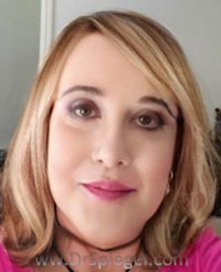 FFS Before & After Gallery - Patient 280457 - Image 4