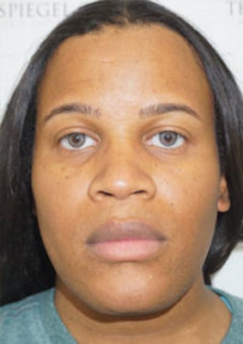 FFS Before & After Gallery - Patient 328442 - Image 1