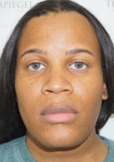 FFS Before & After Gallery - Patient 328442 - Image 1