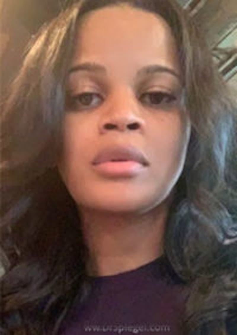 FFS Before & After Gallery - Patient 328442 - Image 4