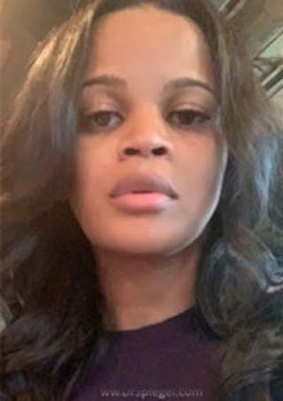 FFS Before & After Gallery - Patient 328442 - Image 4