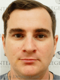 FFS Before & After Gallery - Patient 235658 - Image 1