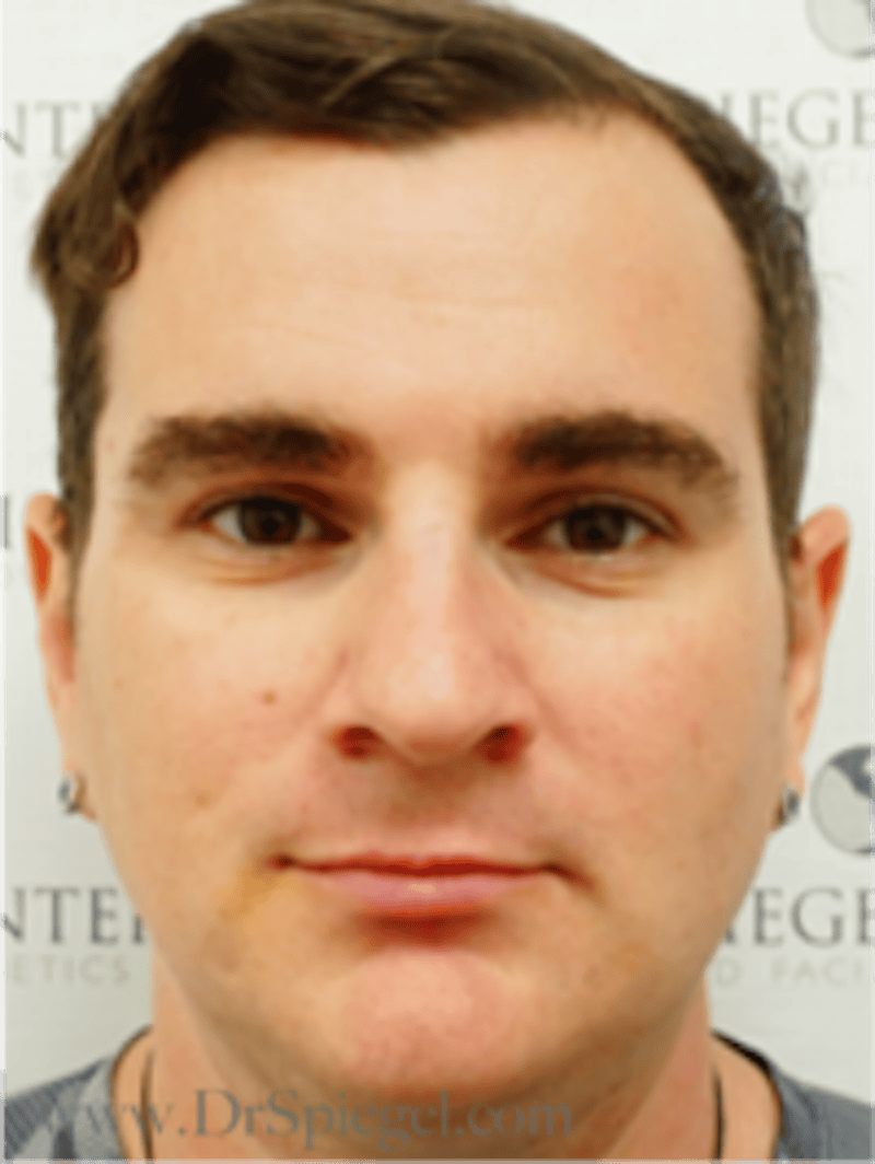 FFS Before & After Gallery - Patient 235658 - Image 1