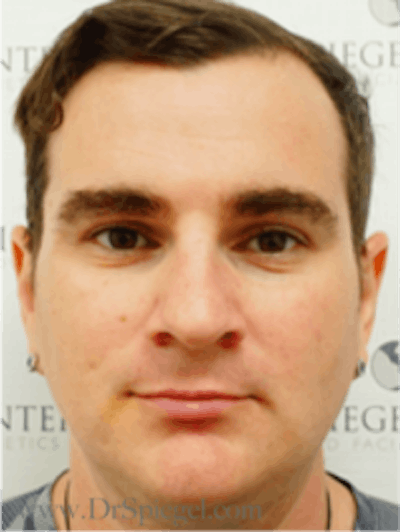 FFS Before & After Gallery - Patient 235658 - Image 1