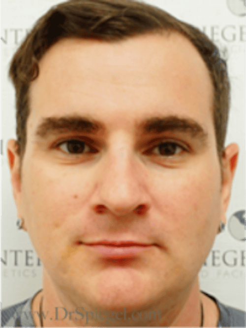 FFS Before & After Gallery - Patient 235658 - Image 1