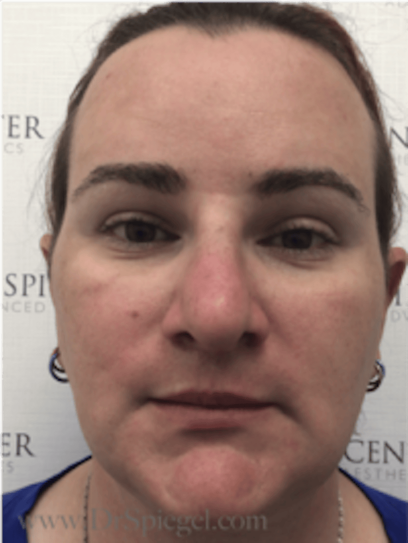 FFS Before & After Gallery - Patient 235658 - Image 2