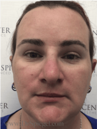 FFS Before & After Gallery - Patient 235658 - Image 2