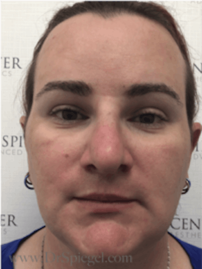 FFS Before & After Gallery - Patient 235658 - Image 2