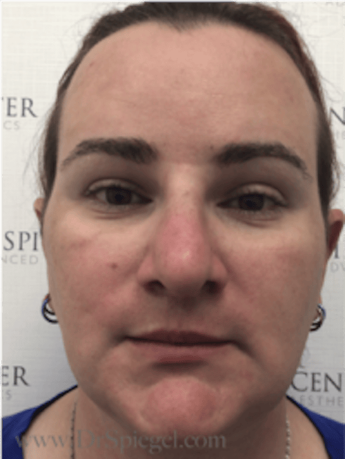 FFS Before & After Gallery - Patient 235658 - Image 2
