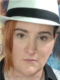 FFS Before & After Gallery - Patient 235658 - Image 4